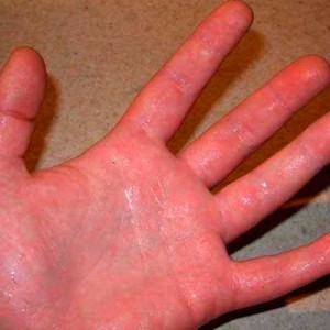 Зуд на ладонях Как избавиться от сильного зуда на руках