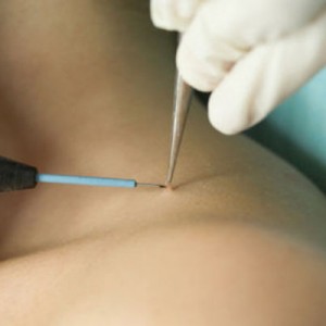 Способы удаления папиллом Папилломы у человека: фото, симптомы заражения и лечение