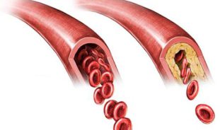 Атеросклероз