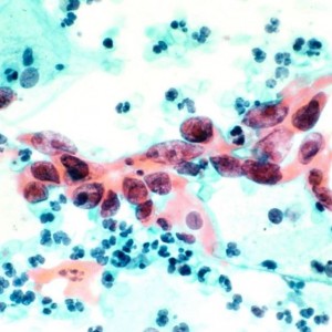 Папилломавирус у человека Чем опасны папилломы и нужно ли их удалять