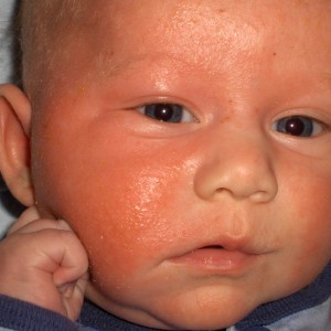 Причины аллергии у грудничков Аллергия у новорожденных на лице: причины и меры профилактики