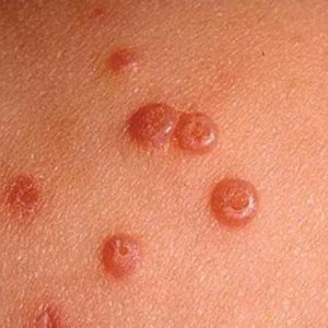 Папилломы Чем опасны папилломы и нужно ли их удалять