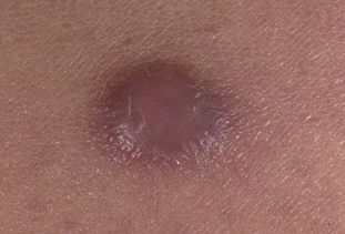 Фото: гистиоцитома