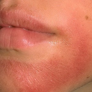 Дермографическая крапивница на лице Дермографическая крапивница: симптомы, диагностика и лечение