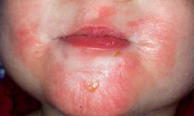 Дерматит запущенная стадия Как побороть аллергический дерматит у взрослых?