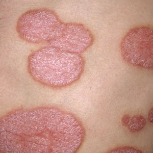 Симптомы псориаза Лечение псориаза на половых органах