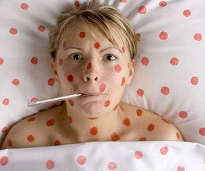 Клинические особенности ветрянки у взрослых Как начинается ветряная оспа у взрослых людей?