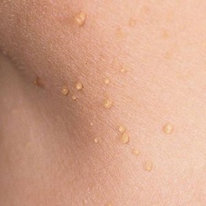 Разновидности папиллом Папилломавирусная инфекция у женщин, фото