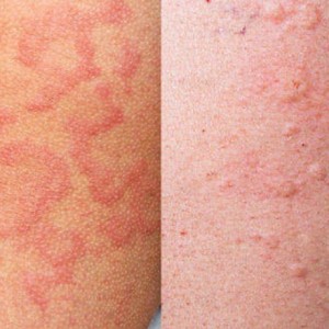 Аллергия красные пятна на теле у ребенка Аллергия. Как она возникает и как ее лечить