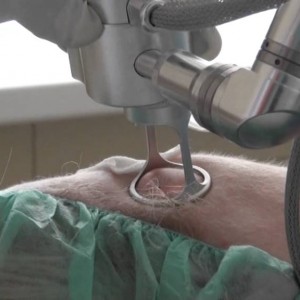 Удаление кератомы Характеристика возрастных бородавок кератом