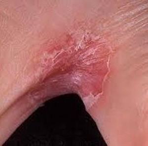 Шелушение кожи между пальцев рук Шелушение кожи на ладонях: причины и профилактика