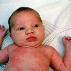 Потница у ребенка Как отличить потницу от аллергии?