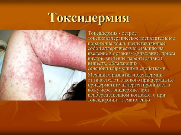 Токсико аллергический дерматит Клинические особенности токсидермии и специфика ее лечения