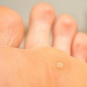 Подошвенные папилломы Проявления папилломавируса у женщин