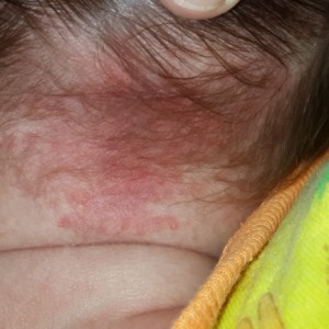 Красное пятно на шее Что делать, если на шее появились красные пятна: фото недуга