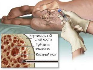 Фото: пункция костного мозга