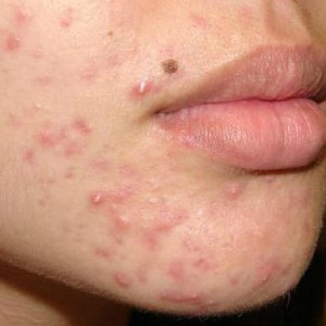 Почему нельзя выдавливать прыщи на лице Можно ли выдавливать прыщи на лице самостоятельно