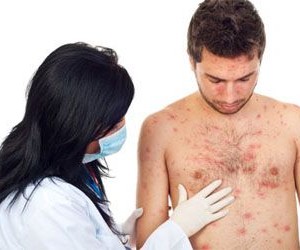 Особенности ветрянки у взрослых Лечение и профилактика ветрянки у взрослых