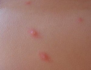 Признаки ветрянки Лечение и профилактика ветрянки у взрослых