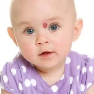 Гемангиома у ребенка У ребенка много родинок на теле