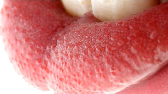 Пупырышки на языке Причины появления белых и красных пупырышек на языке