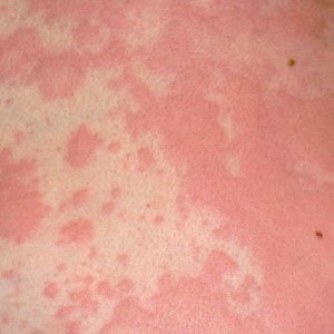 Токсидермия лечение Клинические особенности токсидермии и специфика ее лечения