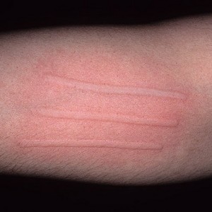 Контактная крапивница Дермографическая крапивница: симптомы, диагностика и лечение