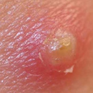 Как лечить чирей? Чем отличаются фурункул и чирей?