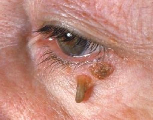 Бородавка на лице Признаки опухолей ВПЧ: виды папиллом, методы удаления