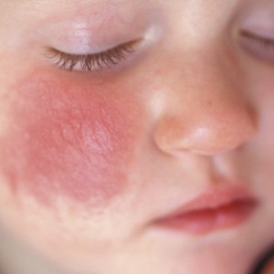 Атопический дерматит Дерматит на руках: причины, симптомы, лечение и фото недуга