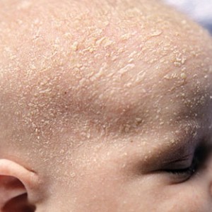 Сухая кожа у младенца Сухая кожа у ребенка: как действовать?