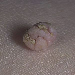 Что такое папиллома фото Папилломы у человека: фото, симптомы заражения и лечение