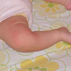 Очень сухая кожа у грудничка Сухая кожа у ребенка: как действовать?