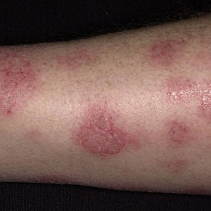 Как лечить дерматит на ногах Что важно знать пациентам с диагнозом «Дерматит ног»