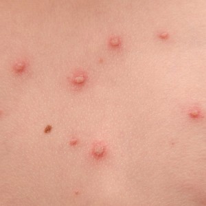 Симптомы ветрянки у взрослых Как начинается ветряная оспа у взрослых людей?