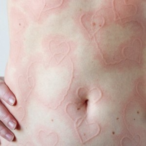 Дермографическая крапивница на теле Дермографическая крапивница: симптомы, диагностика и лечение