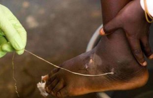 Фото: подкожный червь ришта