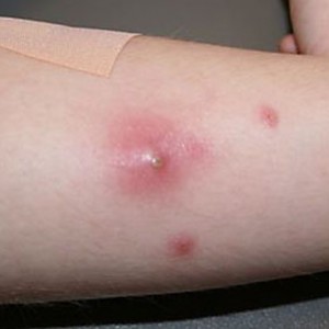 Фурункулез Чем отличаются фурункул и чирей?