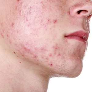 Как выдавить внутренний прыщ на лице Можно ли выдавливать прыщи на лице самостоятельно