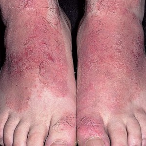 Контактный дерматит Что важно знать пациентам с диагнозом «Дерматит ног»
