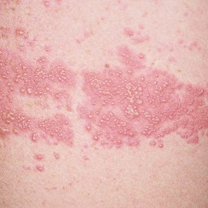 Лишай Можно ли лечить лишай при помощи зеленки