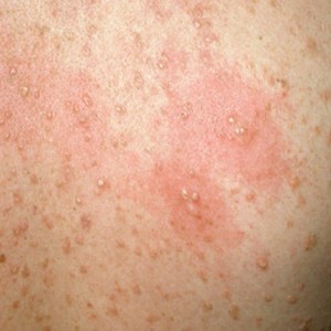 Мастоцитоз фото Мастоцитоз: особенности симптомов и лечения заболевания