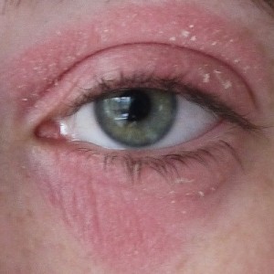 Чешутся шелушатся веки Если чешутся веки: причины и способы лечения