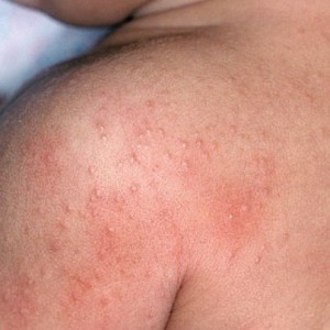 Симптомы потницы Как отличить потницу от аллергии?