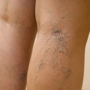 Лечение венозного дерматита Клинические особенности венозного дерматита и подходы к его лечению