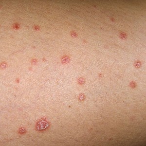 Обычный псориаз Псориаз: симптомы, причины возникновения и лечение