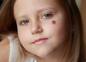 Виды родинок у детей У ребенка много родинок на теле
