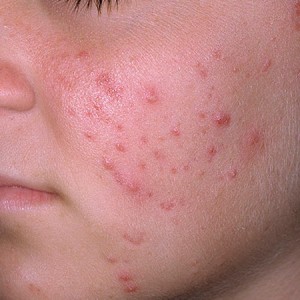 Как выдавить подкожный прыщ на лице Можно ли выдавливать прыщи на лице самостоятельно