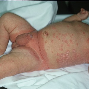 Псориаз у детей Псориаз: симптомы, причины возникновения и лечение