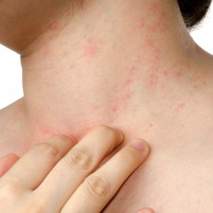 Противозудные мази Мази против зуда кожи и аллегии